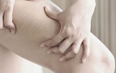 Prevención y tratamiento de las estrías